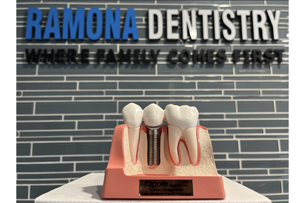 Dental Implants in Fountain Valley, CA 