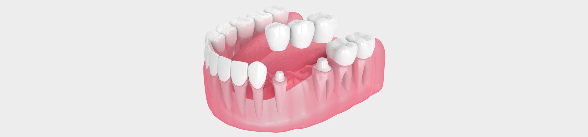 Dental Bridges