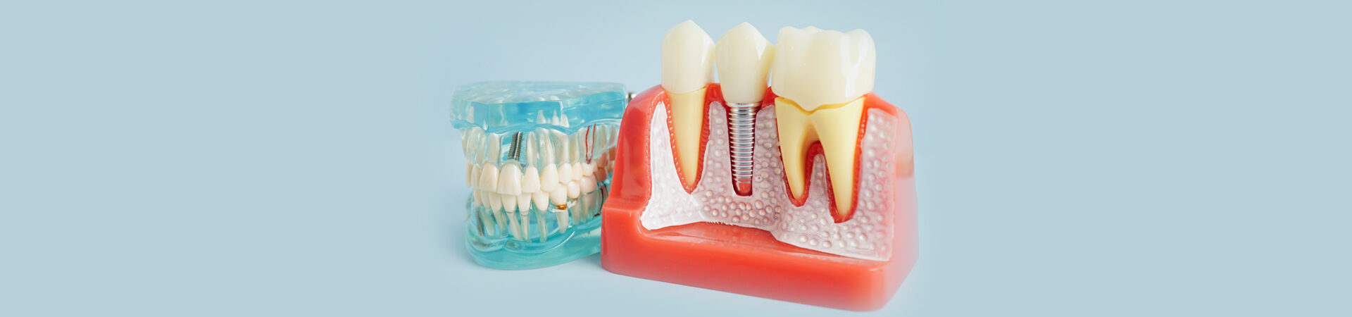 Dental Implants