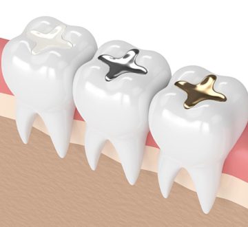 Everything You Need to Know About Dental Fillings