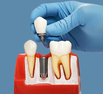 Why Dental Implants Are the Best Solution for Missing Teeth: Expert Insights