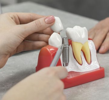 Do Dental Implants Look Natural? What to Expect