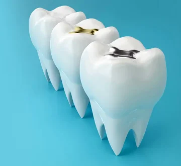 Signs Your Dental Fillings Need Attention: Dentist Expert Guidance